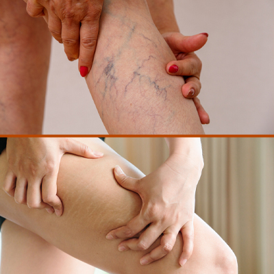 The Difference Between Varicose Veins And Stretch Marks